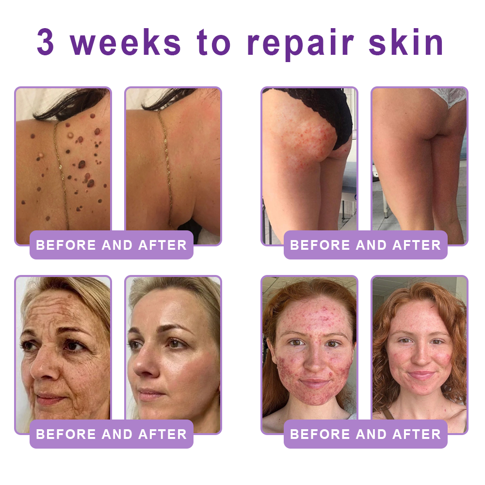 HISKIN® PDRN Multi-Peptide Massaging Body Roller Cream- ✨𝐀𝐧𝐭𝐢-𝐚𝐠𝐢𝐧𝐠, Hydrating, Skin Firming & Lifting, Skin Repair, Even Tone, Acne and Dark Spot Treatment, Wart and Mole Removal, and Psoriasis Relief