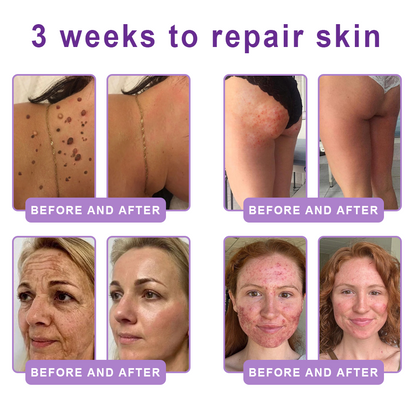 𝐇𝐈𝐒𝐊𝐈𝐍® 𝐏𝐃𝐑𝐍 𝐌𝐮𝐥𝐭𝐢-𝐏𝐞𝐩𝐭𝐢𝐝𝐞 𝐌𝐚𝐬𝐬𝐚𝐠𝐢𝐧𝐠 𝐁𝐨𝐝𝐲 𝐑𝐨𝐥𝐥𝐞𝐫 𝐂𝐫𝐞𝐚𝐦- Anti-aging, Hydrating, Skin Firming & Lifting, Skin Repair, Even Tone, Acne and Dark Spot Treatment, Wart and Mole Removal, and Psoriasis Relief.