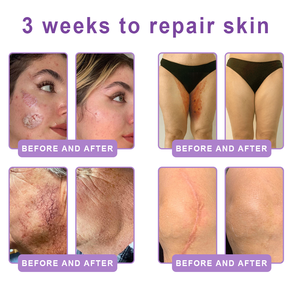 HISKIN® PDRN Multi-Peptide Massaging Body Roller Cream- ✨𝐀𝐧𝐭𝐢-𝐚𝐠𝐢𝐧𝐠, Hydrating, Skin Firming & Lifting, Skin Repair, Even Tone, Acne and Dark Spot Treatment, Wart and Mole Removal, and Psoriasis Relief