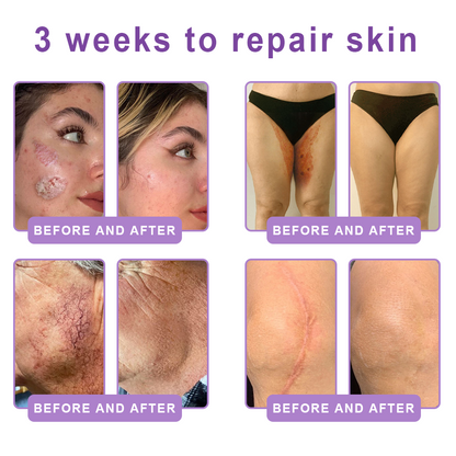 HISKIN® PDRN Multi-Peptide Massaging Body Roller Cream- ✨𝐀𝐧𝐭𝐢-𝐚𝐠𝐢𝐧𝐠, Hydrating, Skin Firming & Lifting, Skin Repair, Even Tone, Acne and Dark Spot Treatment, Wart and Mole Removal, and Psoriasis Relief
