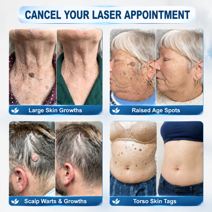 𝐇𝐈𝐒𝐊𝐈𝐍®👩‍⚕️ 𝟕-𝐃𝒂𝘆 𝐒𝗸𝐢𝐧 𝐓𝒂𝗴 & 𝐒𝐩𝙤𝐭 𝐄𝐫𝒂𝐬𝙚𝐫 Painless & Scar-Free Advanced Imper💎