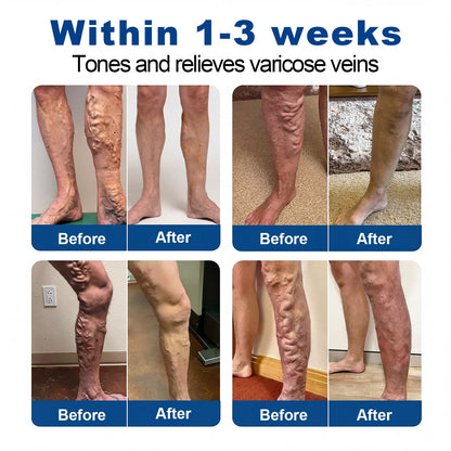 🇦🇺👨‍⚕️✅✅Lexasky® VEIN EASE MICRONEEDLE CARE PATCH⚡Instant Relief, Long-Term Results