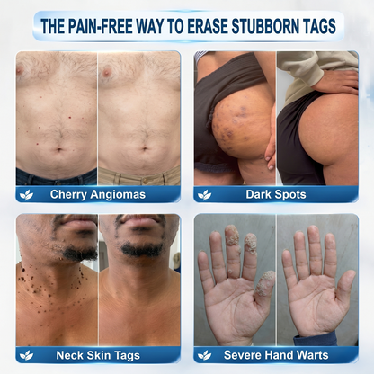 𝐇𝐈𝐒𝐊𝐈𝐍®👩‍⚕️ 𝟕-𝐃𝒂𝘆 𝐒𝗸𝐢𝐧 𝐓𝒂𝗴 & 𝐒𝐩𝙤𝐭 𝐄𝐫𝒂𝐬𝙚𝐫 Painless & Scar-Free Advanced Imper💎