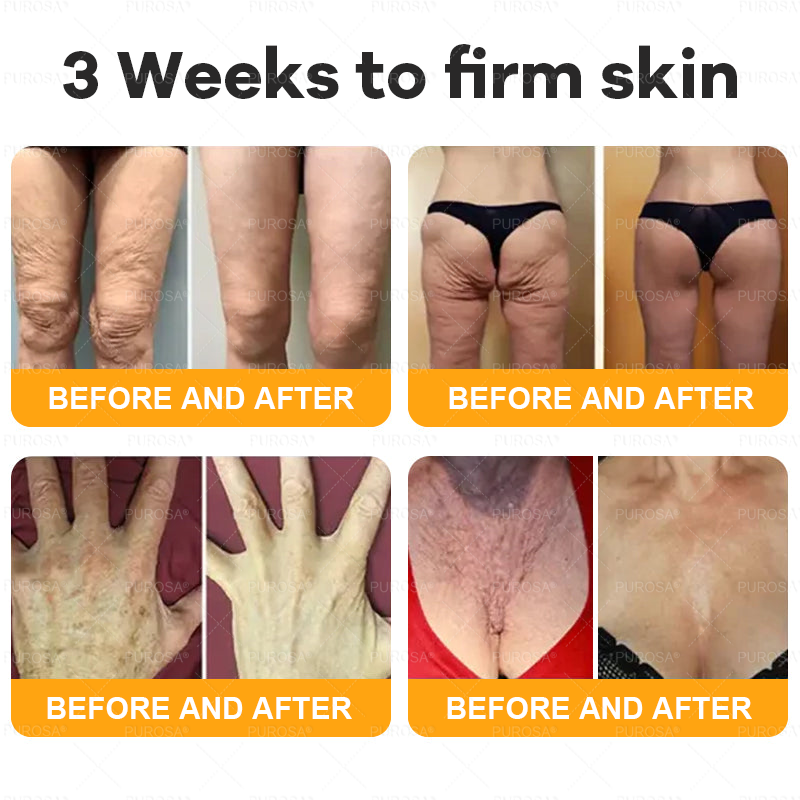Made and Shipped from AU 🌸🌸🌸 PUROSA® BEE VENOM Skin Restoration Cream 🔥 LAST DAY 80% OFF！