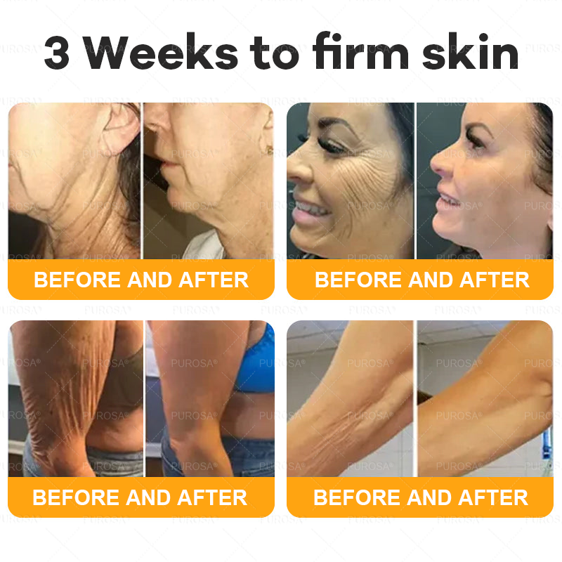 Made and Shipped from AU 🌸🌸🌸 PUROSA® BEE VENOM Skin Restoration Cream 🔥 LAST DAY 80% OFF！