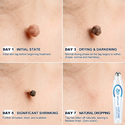 𝐇𝐈𝐒𝐊𝐈𝐍®👩‍⚕️ 𝟕-𝐃𝒂𝘆 𝐒𝗸𝐢𝐧 𝐓𝒂𝗴 & 𝐒𝐩𝙤𝐭 𝐄𝐫𝒂𝐬𝙚𝐫 Painless & Scar-Free Advanced Imper💎