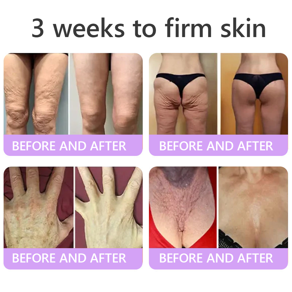 HISKIN® PDRN Multi-Peptide Massaging Body Roller Cream- ✨𝐀𝐧𝐭𝐢-𝐚𝐠𝐢𝐧𝐠, Hydrating, Skin Firming & Lifting, Skin Repair, Even Tone, Acne and Dark Spot Treatment, Wart and Mole Removal, and Psoriasis Relief