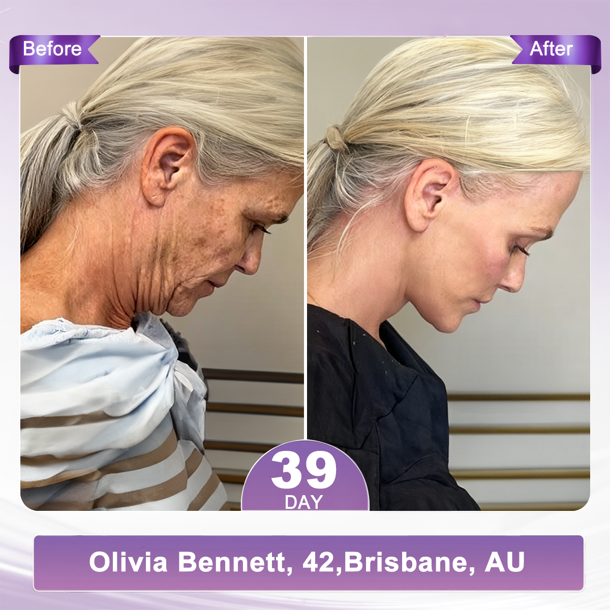 𝐇𝐈𝐒𝐊𝐈𝐍® 𝐏𝐃𝐑𝐍 𝐌𝐮𝐥𝐭𝐢-𝐏𝐞𝐩𝐭𝐢𝐝𝐞 𝐌𝐚𝐬𝐬𝐚𝐠𝐢𝐧𝐠 𝐁𝐨𝐝𝐲 𝐑𝐨𝐥𝐥𝐞𝐫 𝐂𝐫𝐞𝐚𝐦- Anti-aging, Hydrating, Skin Firming & Lifting, Skin Repair, Even Tone, Acne and Dark Spot Treatment, Wart and Mole Removal, and Psoriasis Relief.