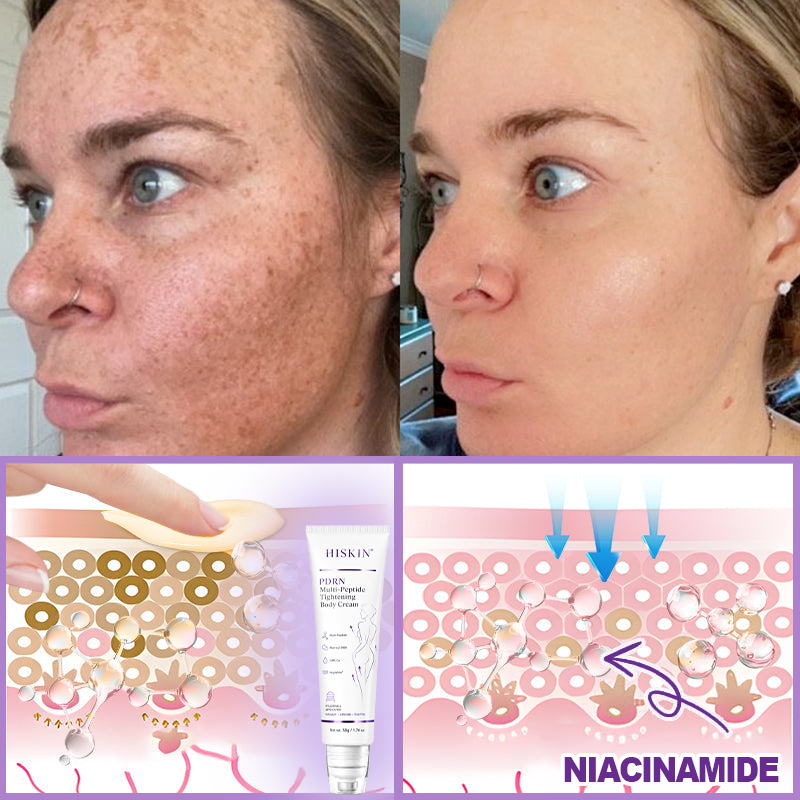 HISKIN® PDRN Multi-Peptide Massaging Body Roller Cream- ✨𝐀𝐧𝐭𝐢-𝐚𝐠𝐢𝐧𝐠, Hydrating, Skin Firming & Lifting, Skin Repair, Even Tone, Acne and Dark Spot Treatment, Wart and Mole Removal, and Psoriasis Relief