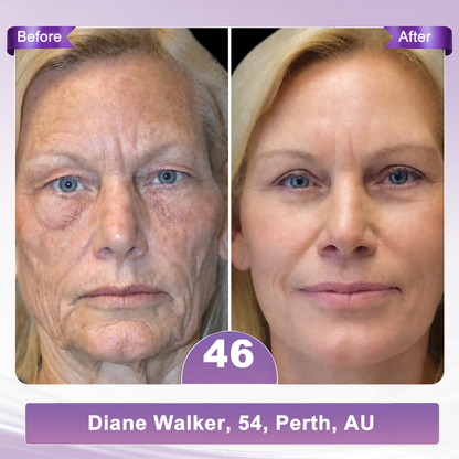 𝐇𝐈𝐒𝐊𝐈𝐍® 𝐏𝐃𝐑𝐍 𝐌𝐮𝐥𝐭𝐢-𝐏𝐞𝐩𝐭𝐢𝐝𝐞 𝐌𝐚𝐬𝐬𝐚𝐠𝐢𝐧𝐠 𝐁𝐨𝐝𝐲 𝐑𝐨𝐥𝐥𝐞𝐫 𝐂𝐫𝐞𝐚𝐦- Anti-aging, Hydrating, Skin Firming & Lifting, Skin Repair, Even Tone, Acne and Dark Spot Treatment, Wart and Mole Removal, and Psoriasis Relief.