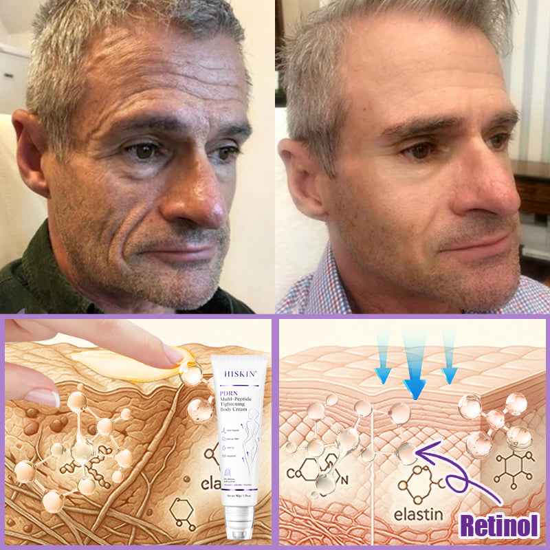 HISKIN® PDRN Multi-Peptide Massaging Body Roller Cream- ✨𝐀𝐧𝐭𝐢-𝐚𝐠𝐢𝐧𝐠, Hydrating, Skin Firming & Lifting, Skin Repair, Even Tone, Acne and Dark Spot Treatment, Wart and Mole Removal, and Psoriasis Relief