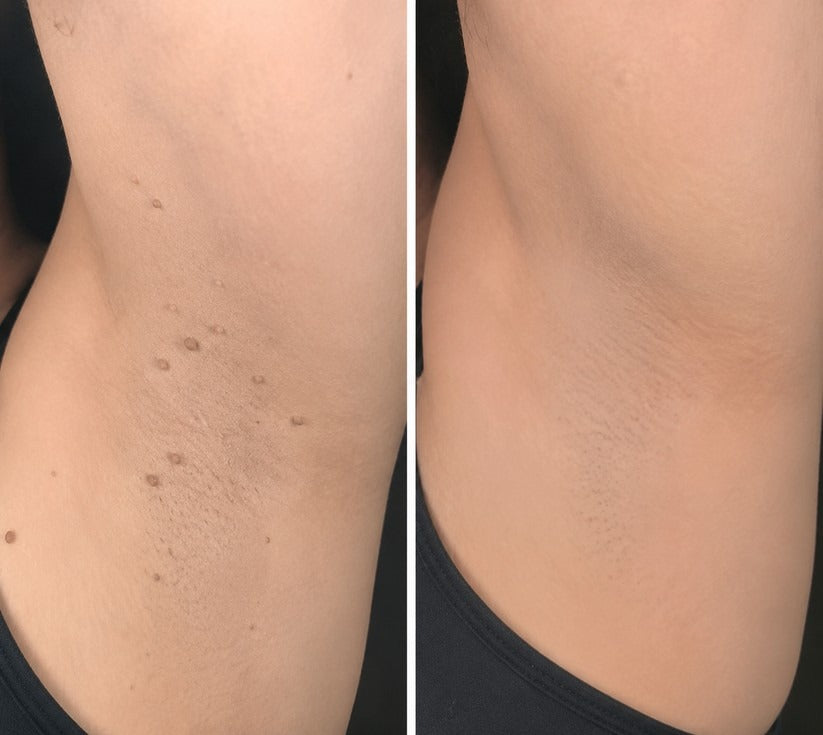 Hiskin ® 2-in-1 Microneedle & Hydrocolloid Patch🍀 | Removes raised moles, acne, flat warts, and skin tags | Helps improve wrinkles, scars, and blemishes | Invisible patches for face and body