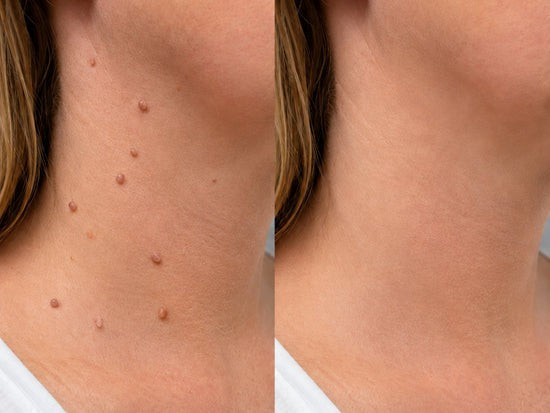 Hiskin ® 2-in-1 Microneedle & Hydrocolloid Patch🍀 | Removes raised moles, acne, flat warts, and skin tags | Helps improve wrinkles, scars, and blemishes | Invisible patches for face and body