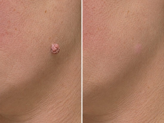 Hiskin ® 2-in-1 Microneedle & Hydrocolloid Patch🍀 | Removes raised moles, acne, flat warts, and skin tags | Helps improve wrinkles, scars, and blemishes | Invisible patches for face and body