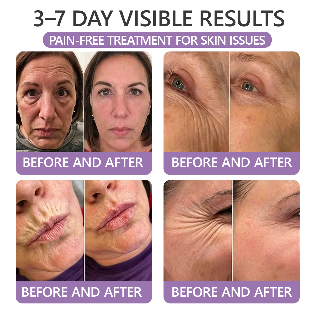 𝐇𝐈𝐒𝐊𝐈𝐍® 𝐏𝐃𝐑𝐍 𝐌𝐮𝐥𝐭𝐢-𝐏𝐞𝐩𝐭𝐢𝐝𝐞 𝐌𝐚𝐬𝐬𝐚𝐠𝐢𝐧𝐠 𝐁𝐨𝐝𝐲 𝐑𝐨𝐥𝐥𝐞𝐫 𝐂𝐫𝐞𝐚𝐦- Anti-aging, Hydrating, Skin Firming & Lifting, Skin Repair, Even Tone, Acne and Dark Spot Treatment, Wart and Mole Removal, and Psoriasis Relief.