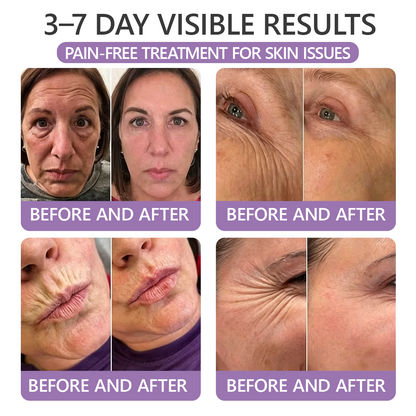 𝐇𝐈𝐒𝐊𝐈𝐍® 𝐏𝐃𝐑𝐍 𝐌𝐮𝐥𝐭𝐢-𝐏𝐞𝐩𝐭𝐢𝐝𝐞 𝐌𝐚𝐬𝐬𝐚𝐠𝐢𝐧𝐠 𝐁𝐨𝐝𝐲 𝐑𝐨𝐥𝐥𝐞𝐫 𝐂𝐫𝐞𝐚𝐦- Anti-aging, Hydrating, Skin Firming & Lifting, Skin Repair, Even Tone, Acne and Dark Spot Treatment, Wart and Mole Removal, and Psoriasis Relief.