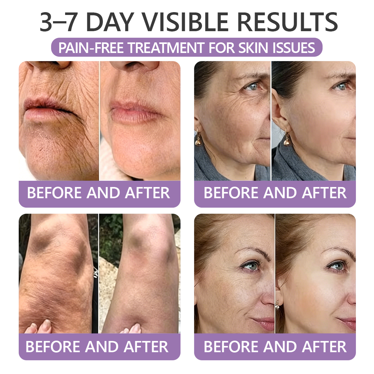 𝐇𝐈𝐒𝐊𝐈𝐍® 𝐏𝐃𝐑𝐍 𝐌𝐮𝐥𝐭𝐢-𝐏𝐞𝐩𝐭𝐢𝐝𝐞 𝐌𝐚𝐬𝐬𝐚𝐠𝐢𝐧𝐠 𝐁𝐨𝐝𝐲 𝐑𝐨𝐥𝐥𝐞𝐫 𝐂𝐫𝐞𝐚𝐦- Anti-aging, Hydrating, Skin Firming & Lifting, Skin Repair, Even Tone, Acne and Dark Spot Treatment, Wart and Mole Removal, and Psoriasis Relief.