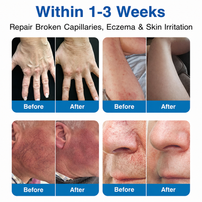 Lexasky® VEIN EASE MICRONEEDLE CARE PATCH⚡Instant Relief, Long-Term Results