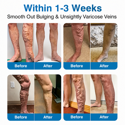 Lexasky® VEIN EASE MICRONEEDLE CARE PATCH⚡Instant Relief, Long-Term Results